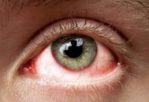 प्रदेश में तेज़ी से फैल रहा है आई फ्लू, यह एहतियात बरत कर हो सकता है बचाव