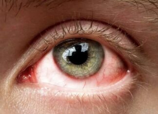 प्रदेश में तेज़ी से फैल रहा है आई फ्लू, यह एहतियात बरत कर हो सकता है बचाव